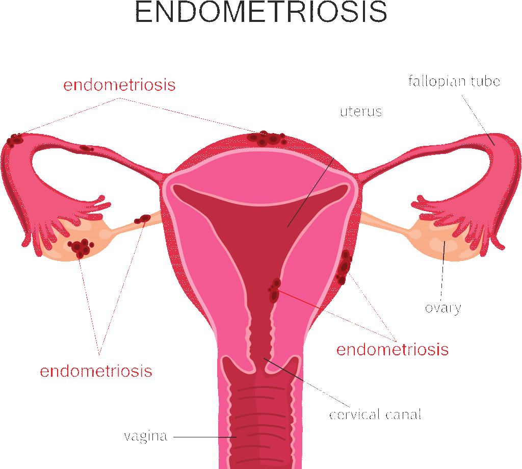 What triggers endometriosis?